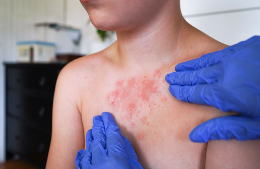 Managing Lichen Planus: Symptoms, Causes, and Fast-Acting Relief