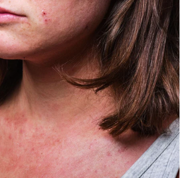 Eczema Flare Ups – How to Manage, Treat and Prevent Them