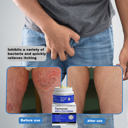 👉 Official Store: Dermynex®️ PCA-Magnesium Herbal Intimate – Multi‑Purpose Relief for Scalp Itching, Eczema, Jock Itch, Facial Acne & Fungal Infections | Herbal Extracts, Steroid‑Free, No Artificial Fragrances, Gentle for All Skin Types【Tax Free】