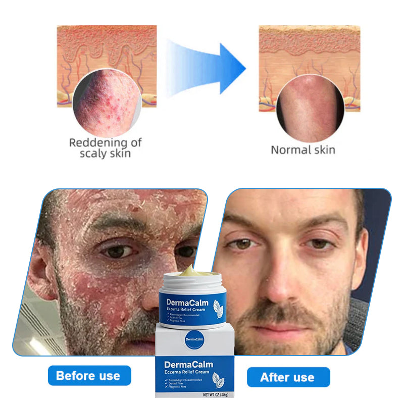 👉 Official Store: Dermacalm®️ PCA-Magnesium Herbal Intimate – Multi‑Purpose Relief for Scalp Itching, Eczema, Jock Itch, Facial Acne & Fungal Infections | Herbal Extracts, Steroid‑Free, No Artificial Fragrances, Gentle for All Skin Types【Tax Free】