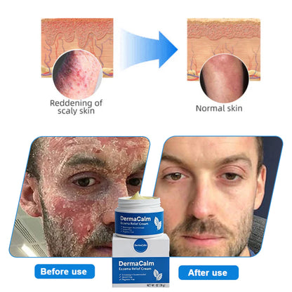 👉 Official Store: Dermacalm®️ PCA-Magnesium Herbal Intimate – Multi‑Purpose Relief for Scalp Itching, Eczema, Jock Itch, Facial Acne & Fungal Infections | Herbal Extracts, Steroid‑Free, No Artificial Fragrances, Gentle for All Skin Types【Tax Free】